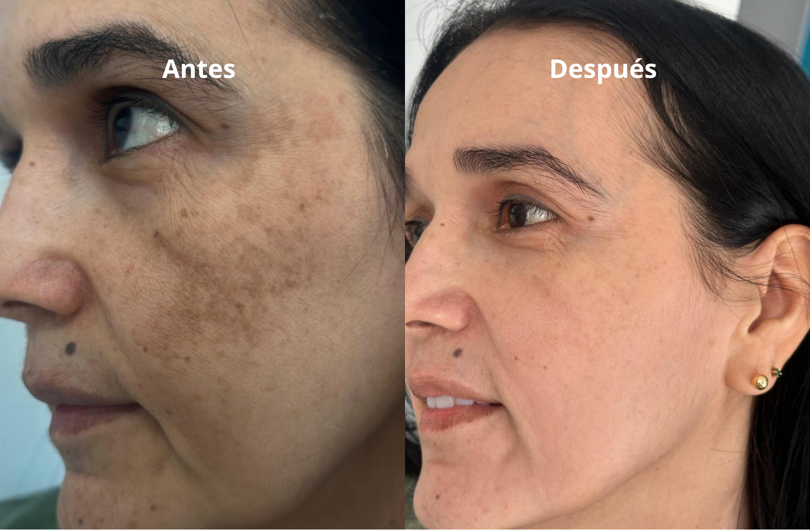 Melasma 1