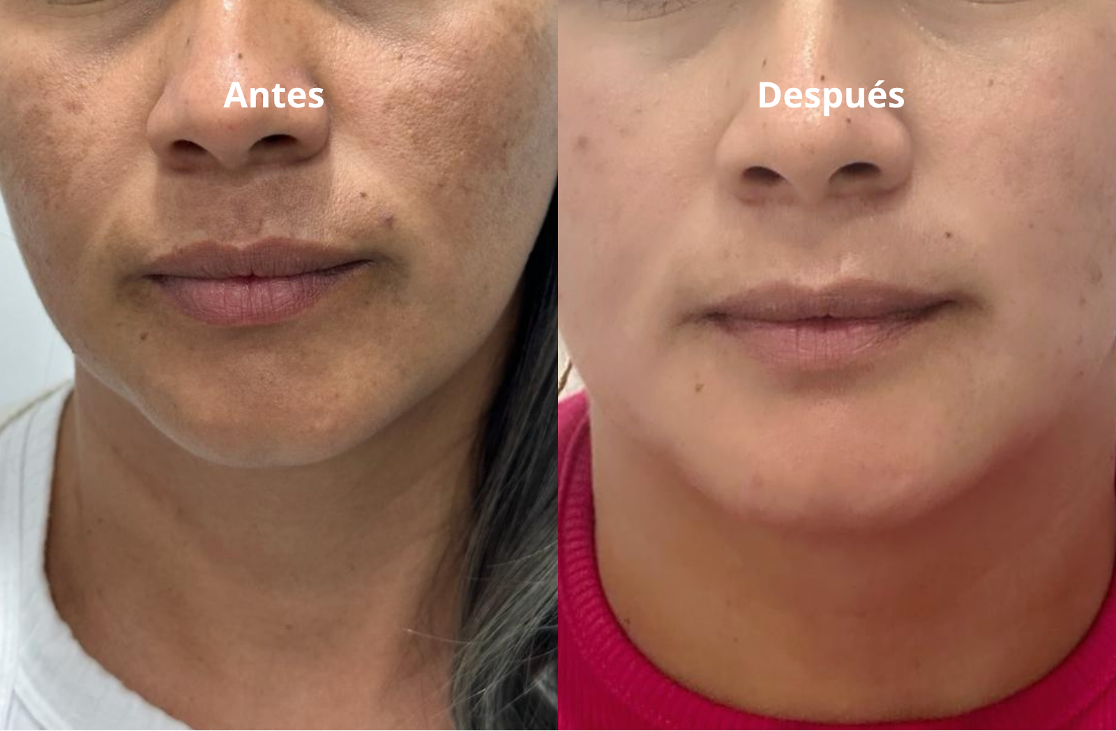 Melasma 2